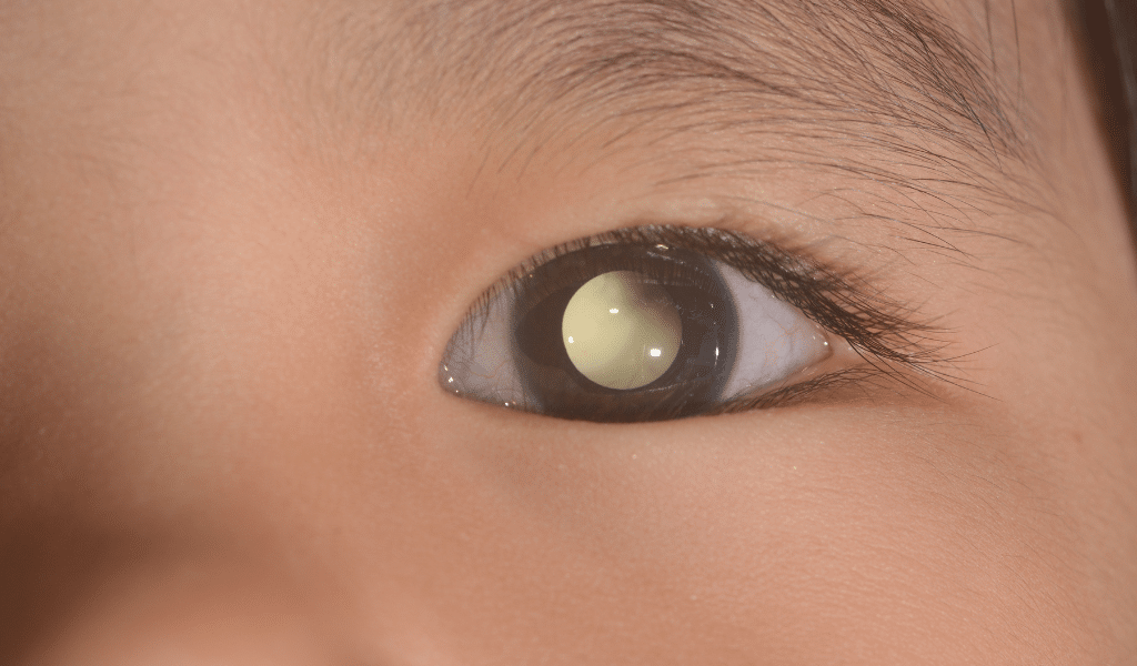 Retinoblastoma metrô