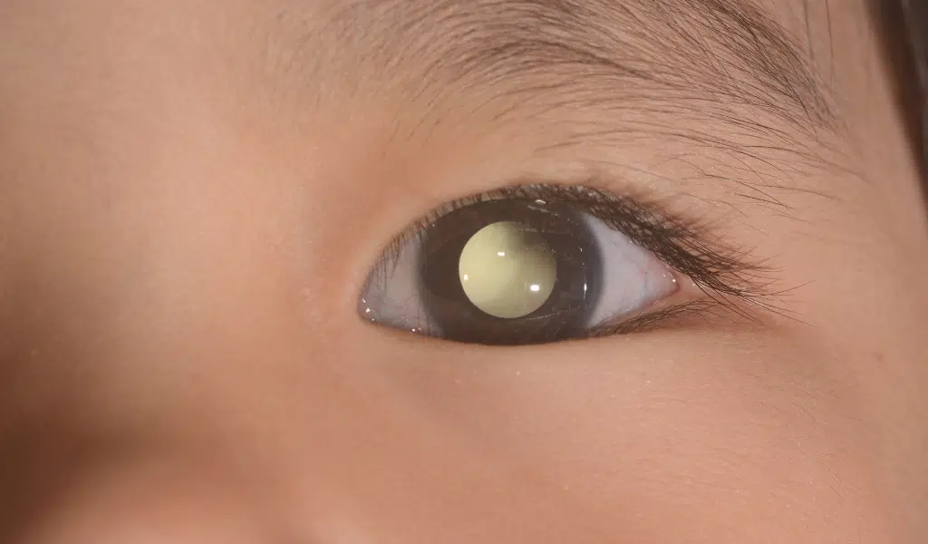 Retinoblastoma metrô